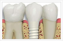 ZIRCONIUM IMPLANT